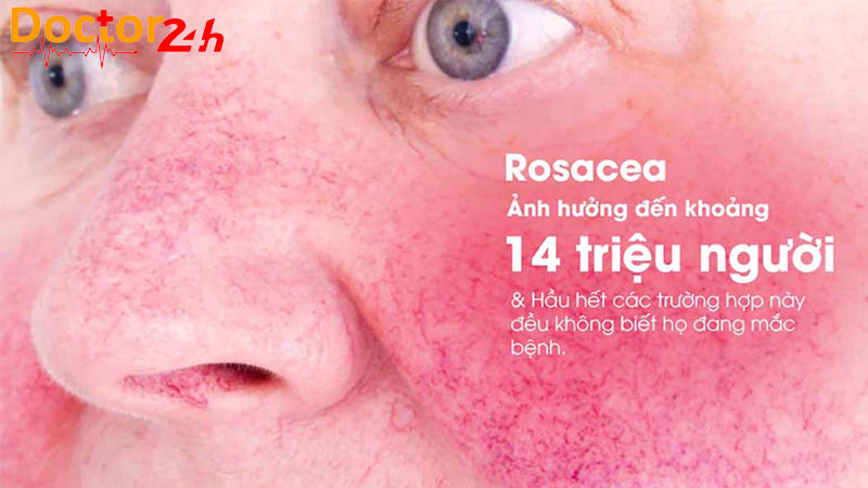 Benh-Rosacea-1