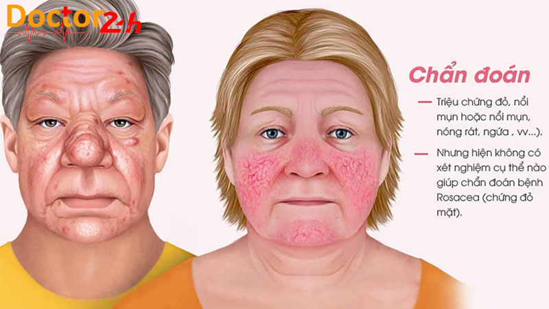Benh-Rosacea-2