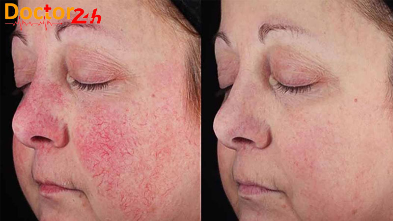 Benh-Rosacea-3