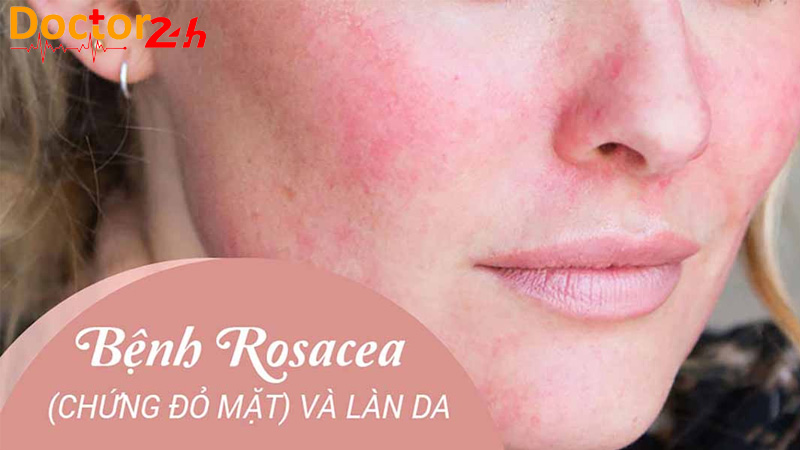 Benh-Rosacea