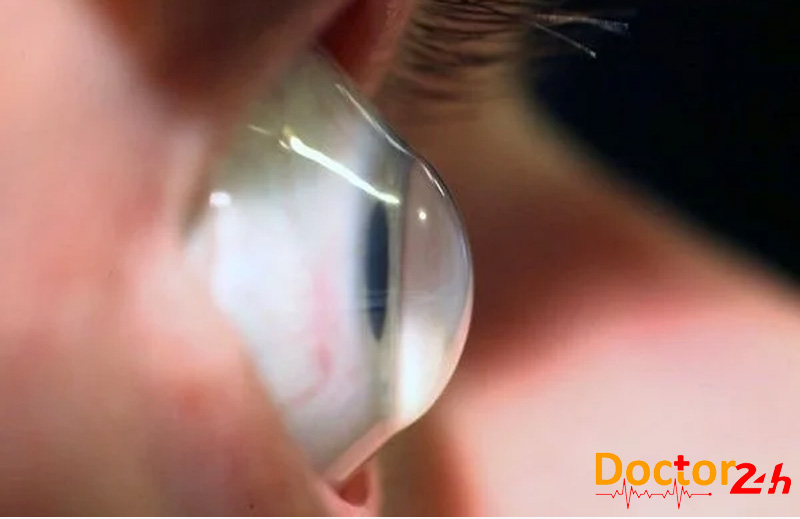 Keratoconus là gì? Triệu chứng, nguyên nhân và điều trị giác mạc hình chóp 1 Keratoconus