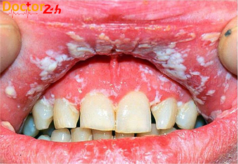 Bệnh nấm Candida và cách điều trị tối ưu nhất 1 benh-nam-Candida