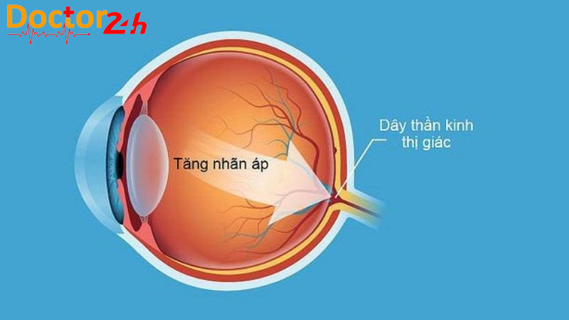 Bệnh Tăng Nhãn áp Bình Thường Là Gì? 2 benh-tang-nhan-ap-binh-thuong