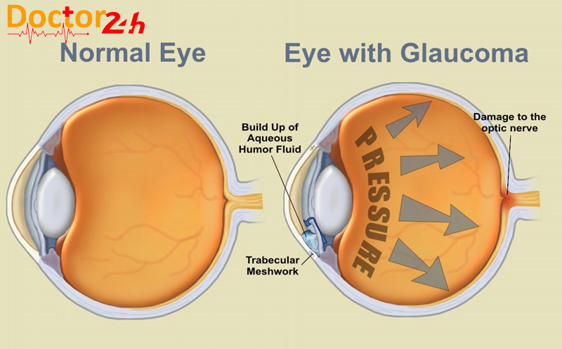 Bệnh Tăng Nhãn áp Bình Thường Là Gì? 1 benh-tang-nhan-ap