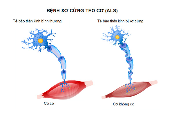 Triệu chứng ban đầu của xơ cứng teo cơ một bên (ALS) là gì? 1 benh-xo-cung-teo-co-ALS