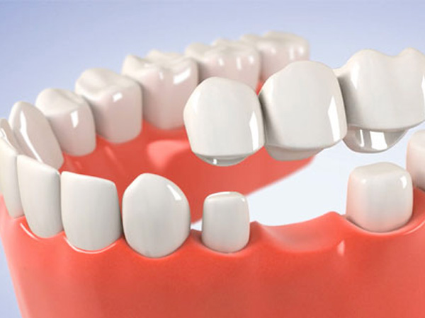 Một pontic (nhịp cầu răng) liên quan đến sức khỏe răng miệng là gì? 1 cau-rang