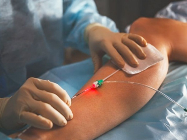 Điều trị bằng laser endovenous để điều trị giãn tĩnh mạch là gì? 1 dieu-tri-laser-endovenous-1