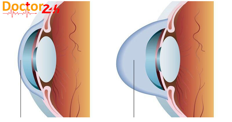 Keratoconus là gì? Triệu chứng, nguyên nhân và điều trị giác mạc hình chóp 2 Keratoconus