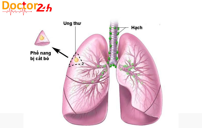 Hạch phổi là gì 1 hach-phoi-la-gi