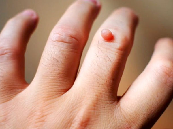 Mụn cóc periungual là gì? 1 mun-coc