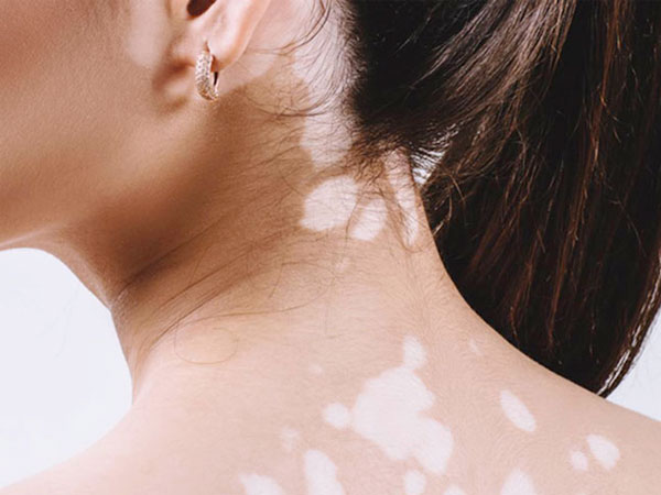 Triệu chứng nấm lang ben và cách điều trị 1 nam-lang-ben