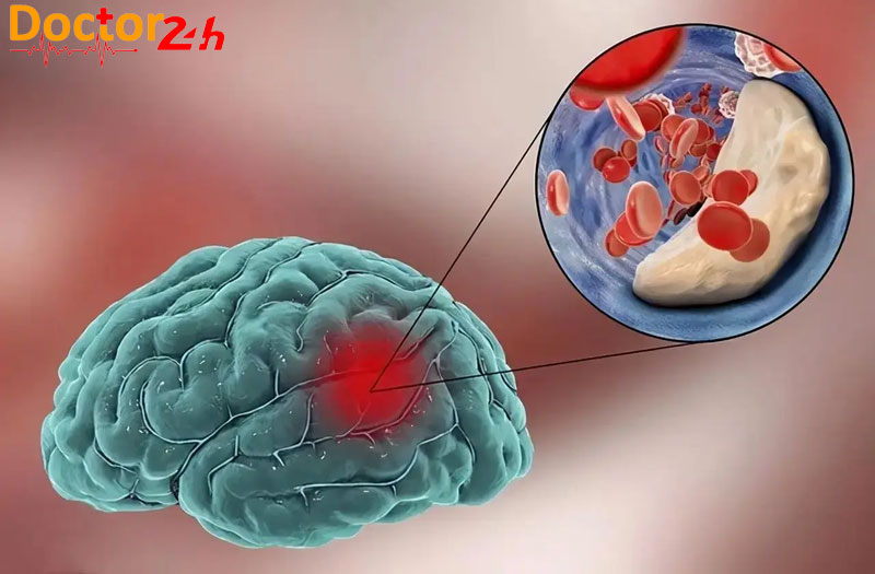 Cảnh báo nguy cơ mắc xuất huyết não ở người bị tăng huyết áp 1 nguy-co-xuat-huyet-nao