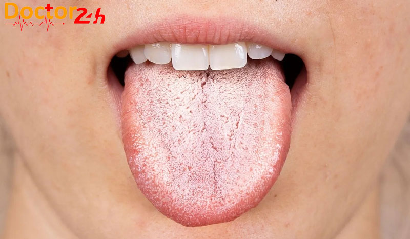 Khái niệm cơ bản về nứt lưỡi, nguyên nhân và cách điều trị 2 nguyen-nhan-nut-luoi