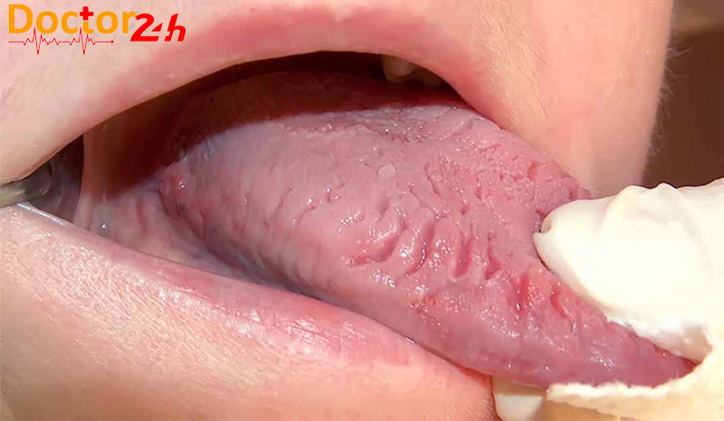 Khái niệm cơ bản về nứt lưỡi, nguyên nhân và cách điều trị 1 nut-luoi