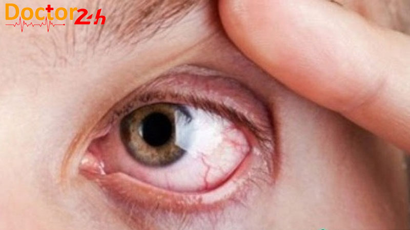 Bệnh Tăng Nhãn áp Bình Thường Là Gì? 3 tang-nhan-ap