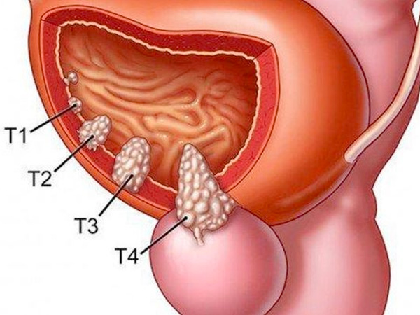 ung thu bang quang 1