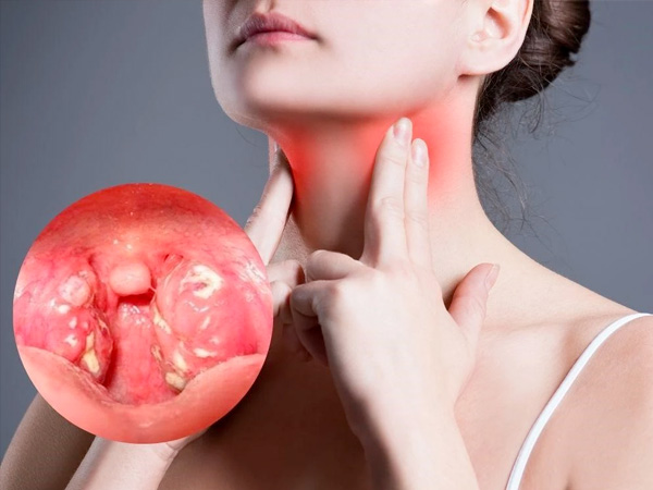 Bệnh viêm amidan: Nguyên nhân, triệu chứng và điều trị 1 viem-amidan