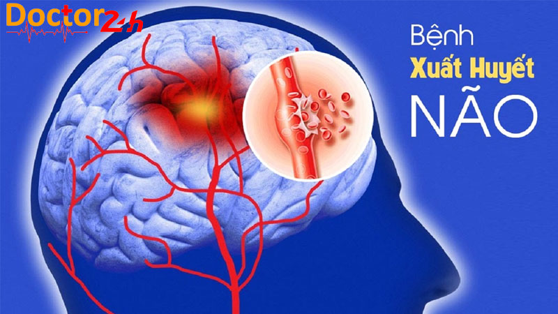 Cảnh báo nguy cơ mắc xuất huyết não ở người bị tăng huyết áp 2 xuat-huyet-nao