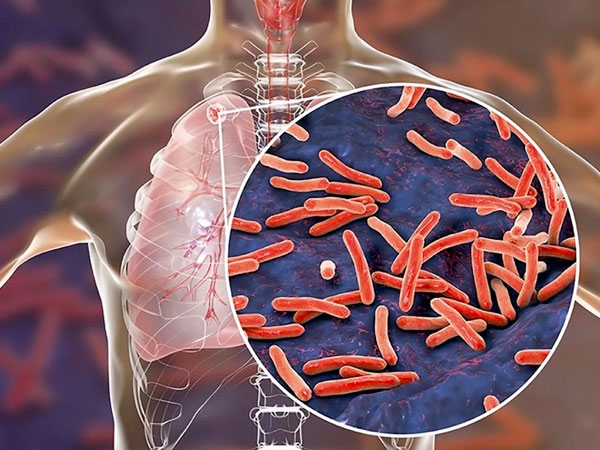 Bệnh lao ở người nhiễm HIV - AIDS 1 benh-lao-dong-nhim-hiv