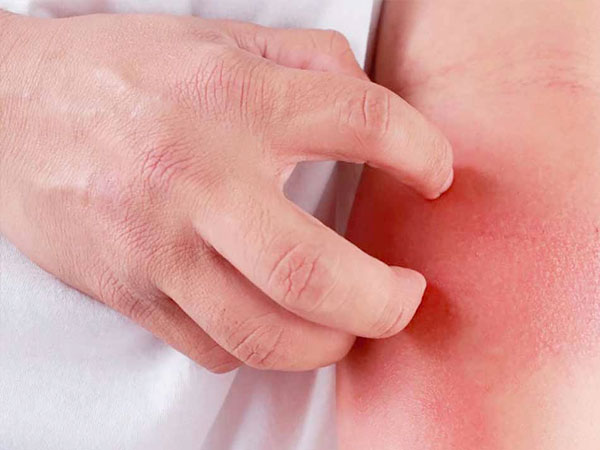 Thông tin cơ bản bạn cần biết về Dị Ứng 1 di-ung