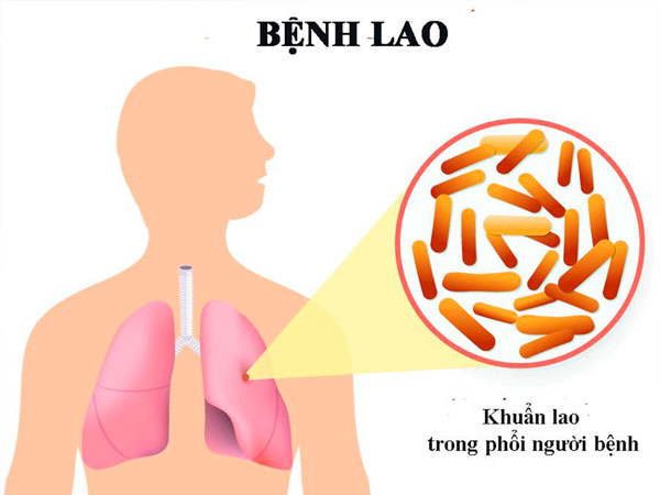 Cần làm gì khi có người nhà mắc bệnh lao? 1 nguoi-nha-mac-benh-lao