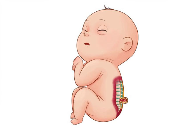 Tật Nứt Đốt Sống là gì ? 1 tan-nut-dot-song