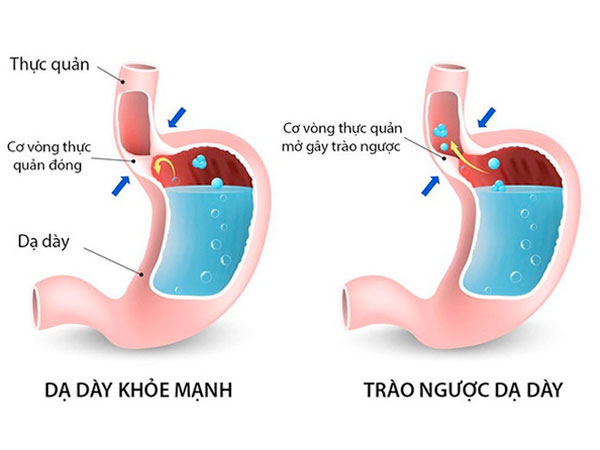 Bệnh Trào Ngược Dạ Dày Thực Quản 1 trao-nguoc-da-day-thuc-quan