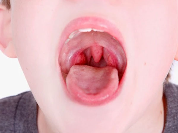 Cập nhật điều trị và chăm sóc đối với trẻ cắt amiđan 1 tre-cat-amidan