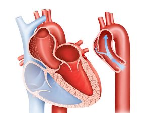 boc-tach-dong-mach-vanh-tu-phat