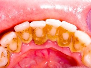 Tác hại của cao răng 13 cao-rang
