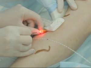 dieu-tri-laser-endovenous