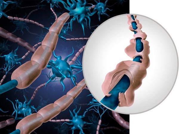 hoi-chung-Guillain-–-Barre-(GBS)