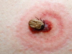 Nên làm gì khi bị bọ chét cắn ? 1 lam-gi-khi-bi-bo-chet-can