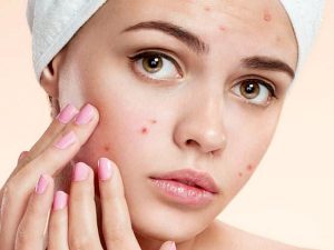 Câu Hỏi Thường Gặp Về Mụn Trứng Cá 16 mun