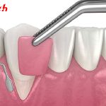 phau-thuat-ghep-nuou