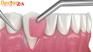 phau-thuat-ghep-nuou