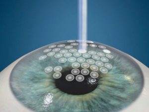 phuong-phap-Photorefractive-Keratectomy-(PRK)