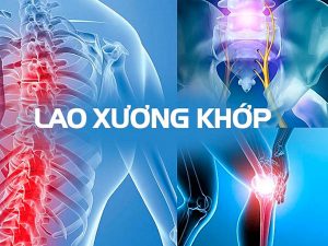 benh-lao-xuong-khop