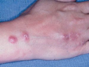 benh-nam-Sporotrichosis