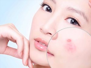 Hiện tượng nổi mụn trên da mặt 14 noi-mun-tren-da-mat