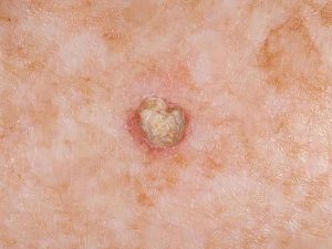 su-dung-cong-nghe-vi-song-dieu-tri-da