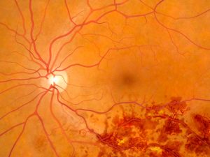 benh-tac-tinh-mach-vong-mac