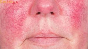 mat-do-nong-bung-la-benh-gi