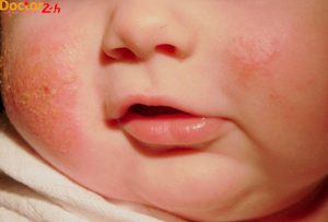 chua-cham-sua-so-sinh-bang-meo-dan-gian